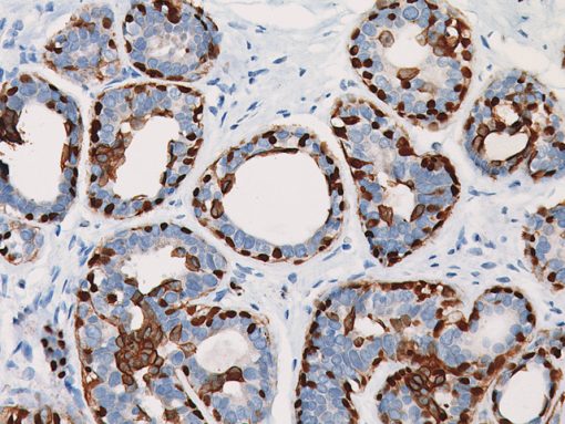 Breast cancer stained with CK5 + p63