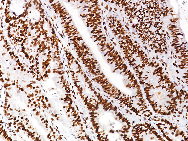 Colon cancer stained with MSH6 antibody