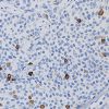 Breast cancer stained with Mammaglobin antibody