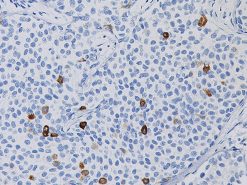Breast cancer stained with Mammaglobin antibody