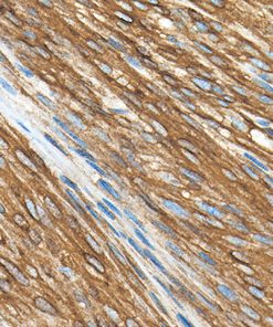 GIST stained with CD117/c-Kit antibody rabbit monoclonal