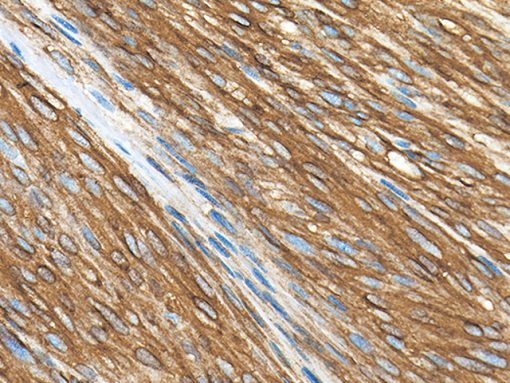 GIST stained with CD117/c-Kit antibody rabbit monoclonal