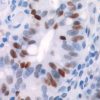 Colon cancer stained with p53 antibody