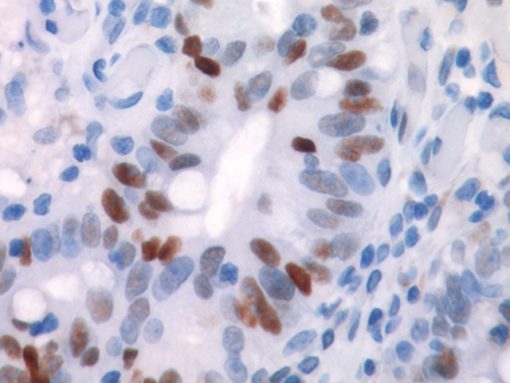 Colon cancer stained with p53 antibody