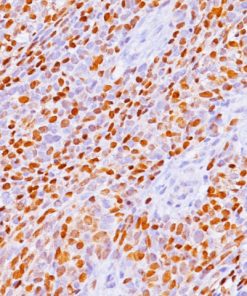 Rhabdomyosarcoma stained with Myogenin Antibody