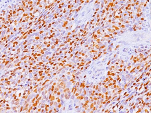 Rhabdomyosarcoma stained with Myogenin Antibody
