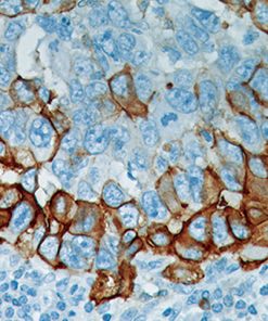 Breast cancer stained with Epidermal Growth Factor Receptor Antibody
