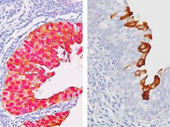 (L) Bladder CIS & (R) Reactive atypia in bladder stained with Uro-2™