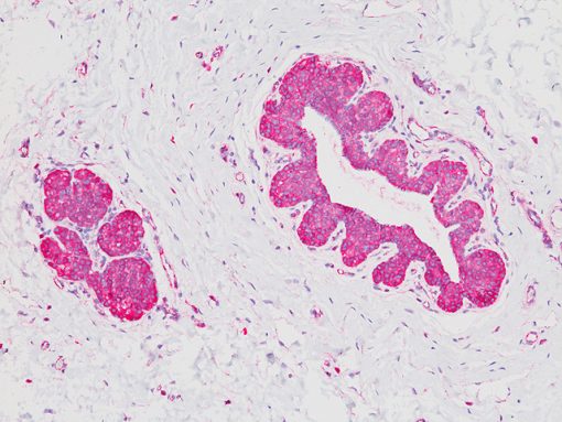 Lobular breast carcinoma in situ stained with p120 Catenin antibody