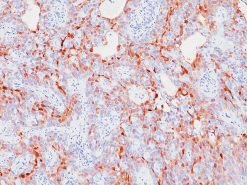 Bladder cancer stained with S100P antibody
