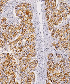 Breast ductal cell carcinoma stained with E-Cadherin antibody (RM)