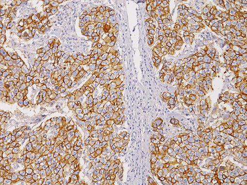 Breast ductal cell carcinoma stained with E-Cadherin antibody (RM)