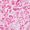 Prostate cancer stained with AMACR antibody (P504S)