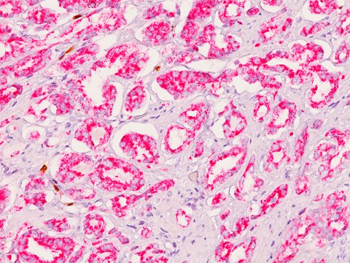 Prostate cancer stained with AMACR antibody (P504S)