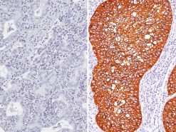 (L) Desmoglein 3 + CK5 negative in lung adenocarcinoma (R) Desmoglein 3 + CK5 antibody positive in lung SqCC