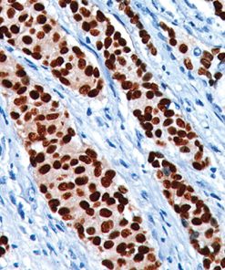 Breast cancer stained with PR antibody