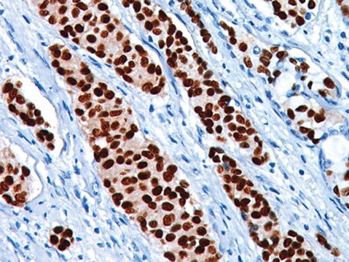 Breast cancer stained with PR antibody