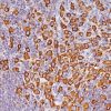 Breast cancer stained with Epithelial Membrane Antigen (EMA) [E29]