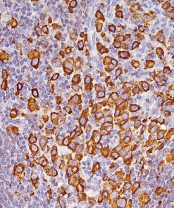 Breast cancer stained with Epithelial Membrane Antigen (EMA) [E29]