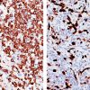 (L) Anaplastic large cell lymphoma and (R) Lung adenocarcinoma stained with ALK antibody [5A4]