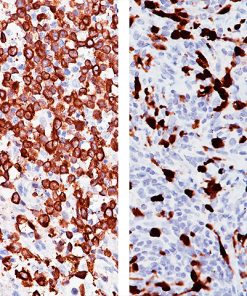 (L) Anaplastic large cell lymphoma and (R) Lung adenocarcinoma stained with ALK antibody [5A4]