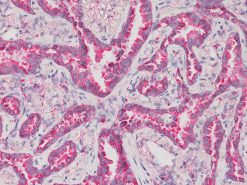 Lung adenocarcinoma stained with Napsin A