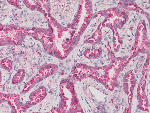 Lung adenocarcinoma stained with Napsin A