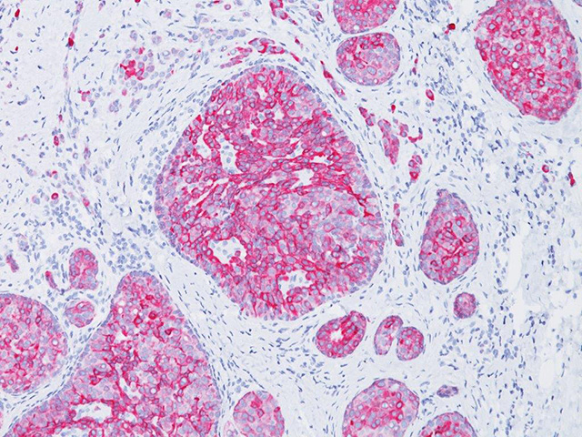 Breast cancer stained with CK7/18 antibody cocktail