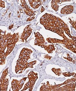 Bladder cancer stained with Uroplakin II antibody