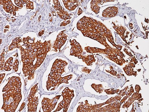 Bladder cancer stained with Uroplakin II antibody