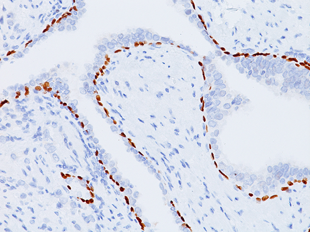 Prostate tissue stained with p63 prostate antibody, 3X