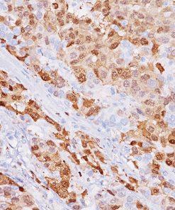 Hepatocellular carcinoma (HCC) stained with Arginase-1 Antibody