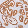 Colon cancer stained with Cytokeratin 18 antibody
