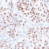 Lung SqCC stained with p40 antibody (M)