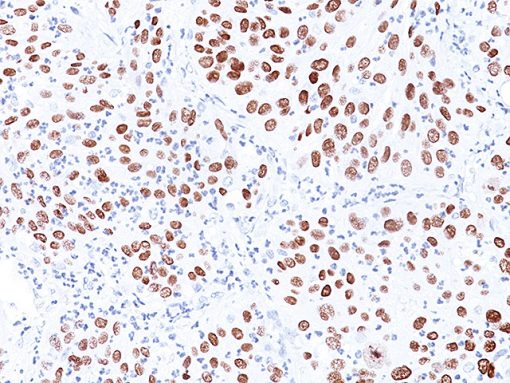 Lung SqCC stained with p40 antibody (M)