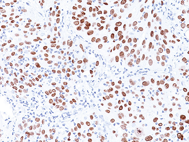 Lung SqCC stained with p40 (M)