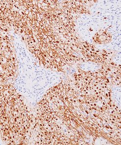 Lung squamous cell carcinoma stained with Desmoglein 3 + p40 antibody