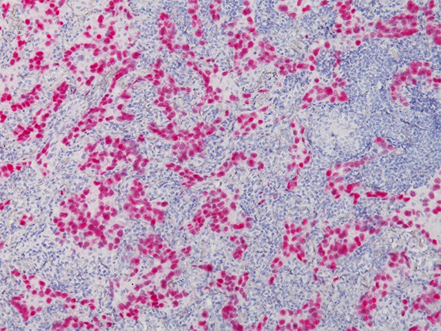 Lung Adenocarcinoma stained with TTF-1, 2X