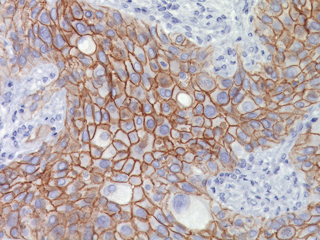lung SqCC stained with Desmoglein 3, 2X