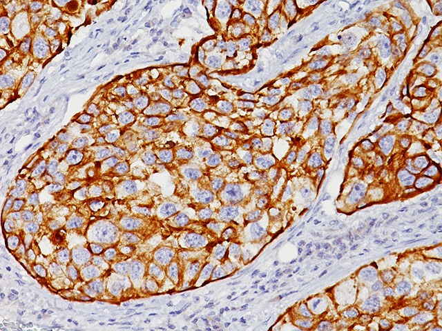 Bladder Cancer stained with CK20 antibody, 2X