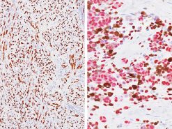 SOX10 Antibody, (Left) Spindle cell melanoma (DAB) Antibody; (Right) Pigmented melanoma (Fast red) Antibody