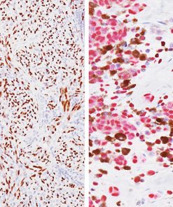 SOX10 Antibody, (Left) Spindle cell melanoma (DAB) Antibody; (Right) Pigmented melanoma (Fast red) Antibody
