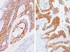 (Left) Colon adenocarcinoma stained with CDH17 antibody; (Right) Stomach adenocarcinoma stained with CDH17 antibody