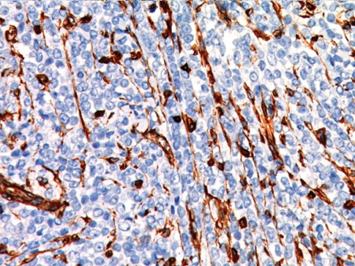 Tissue stained with Vimentin rabbit antibody.