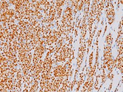Mantle cell lymphoma stained with SOX11 (M) antibody