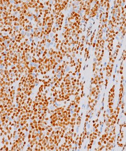 Mantle cell lymphoma stained with SOX11 (M) antibody