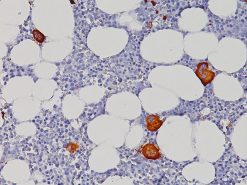 Megakaryocyte in bone marrow stained with CD11c (Leu-M5) antibody