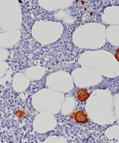 Megakaryocyte in bone marrow stained with CD11c (Leu-M5) antibody