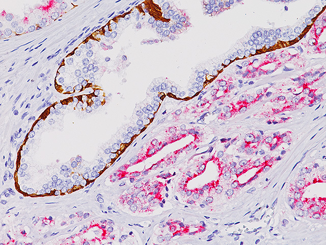 Prostate cancer stained with CK HMW + p63 + AMACR (RM)