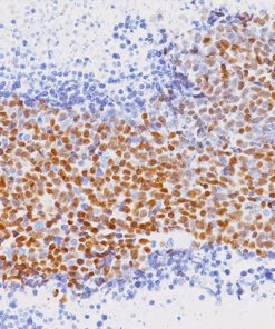 Small cell lung cancer stained with MASH1 antibody